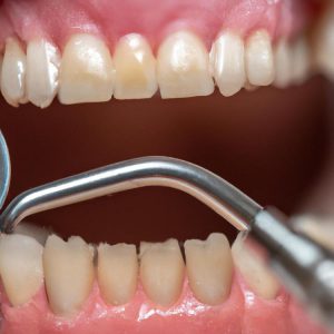 Kiedy zarośnie dziura po wyrwaniu zęba?